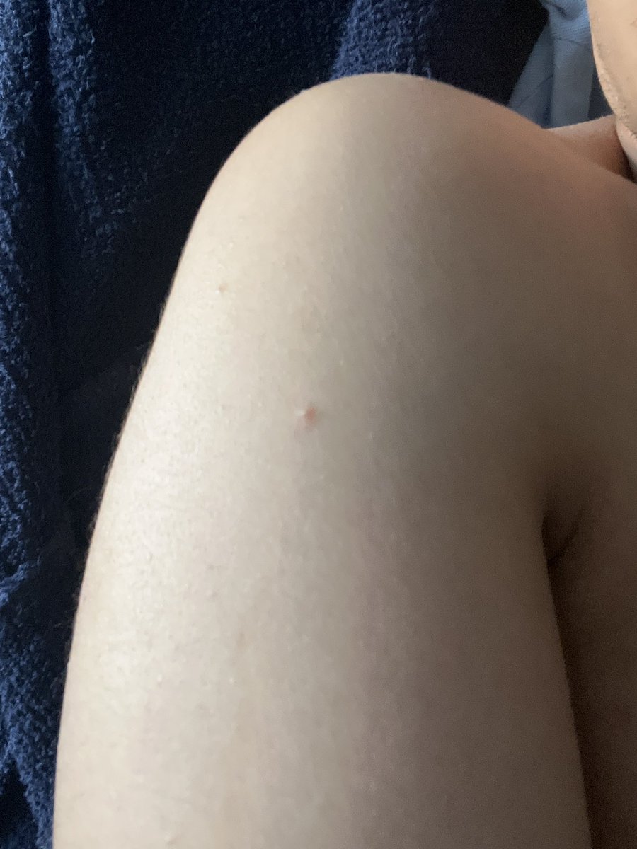 جمعه طيبه عندي حساسيه واش علاج الاحساسيه