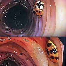 InternetH0F's tweet image. During a colonoscopy performed on a 59-year-old man, an unexpected host was found in his intestine