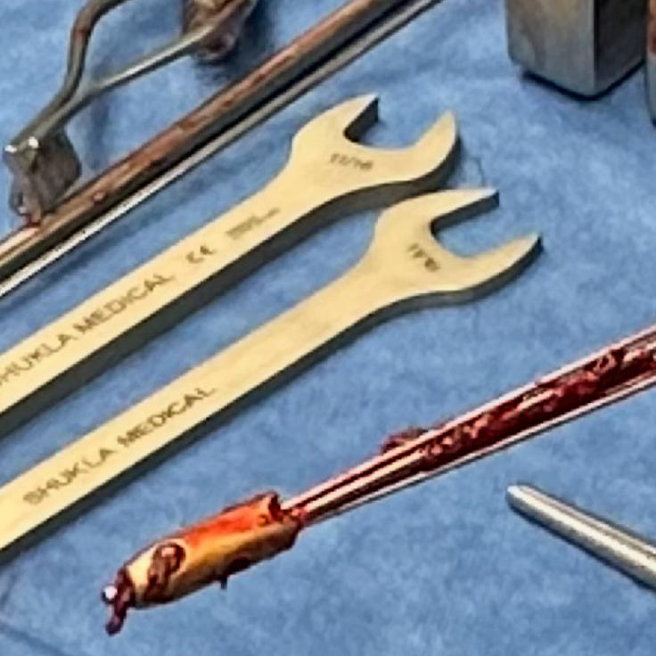 ShuklaMedical's tweet image. Never let a broken IM nail hold you back! 💪This one was successfully #extracted with the SHUKLA Broken Nail System. Bring Shukla to your next #orthopedic #revision #surgery.

#ShuklaSuccessStory #orthopedics #orthopaedics #IMnail #extraction #orthotwitter