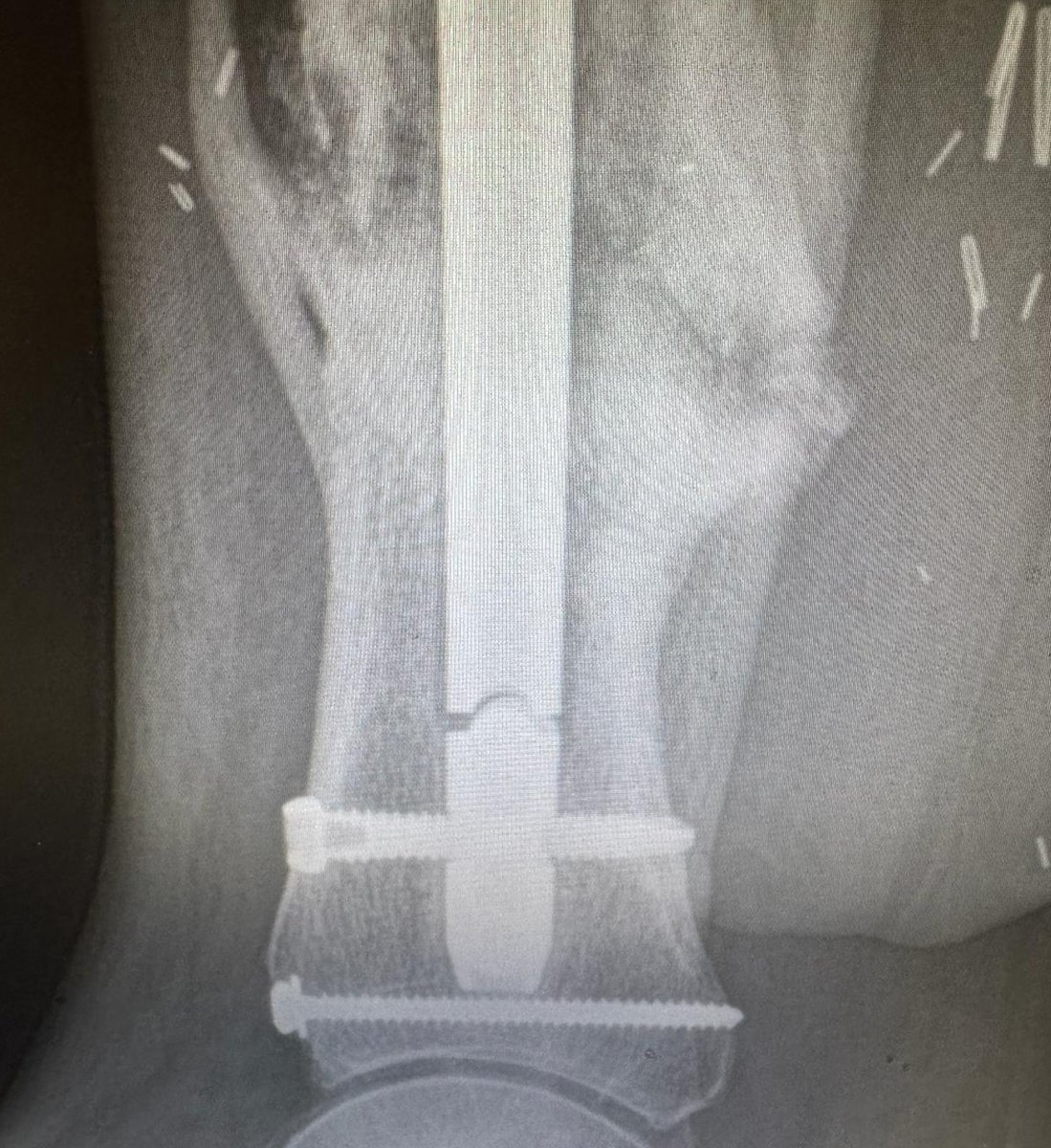 ShuklaMedical's tweet image. Never let a broken IM nail hold you back! 💪This one was successfully #extracted with the SHUKLA Broken Nail System. Bring Shukla to your next #orthopedic #revision #surgery.

#ShuklaSuccessStory #orthopedics #orthopaedics #IMnail #extraction #orthotwitter