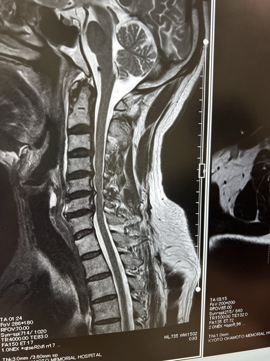 術後後22日目。相変わらず、右手の動きが悪い.首の痛み強い。けど、そろそろ退院のメドを考えていかなければならないのかな。今は地域包括ケア病棟にいる。ここでは自宅に帰る為のリハビリ。思ったより回復がないので自宅に帰っても心配。ふと手術前のレントゲンを思い出した。
＃頚椎症性脊髄症