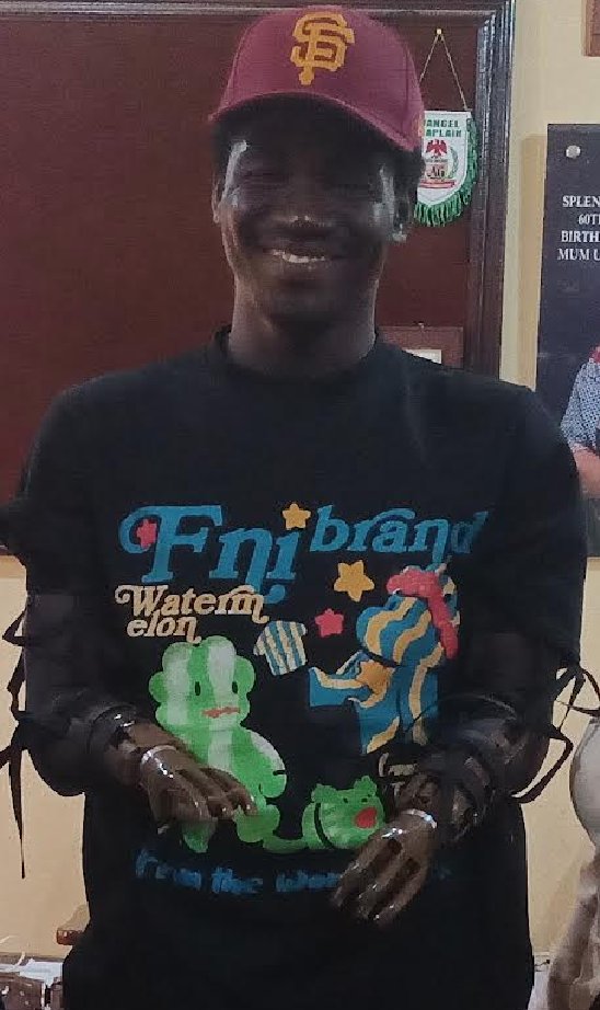 LN4HandProject's tweet image. This young man has been waiting 11 years to receive two prosthetic hands after losing his own to an electrical accident at the young age of 18. We are so thankful our Ambassadors in Nigeria could help him out so quickly and making this dream a reality! ✨✨✨✨