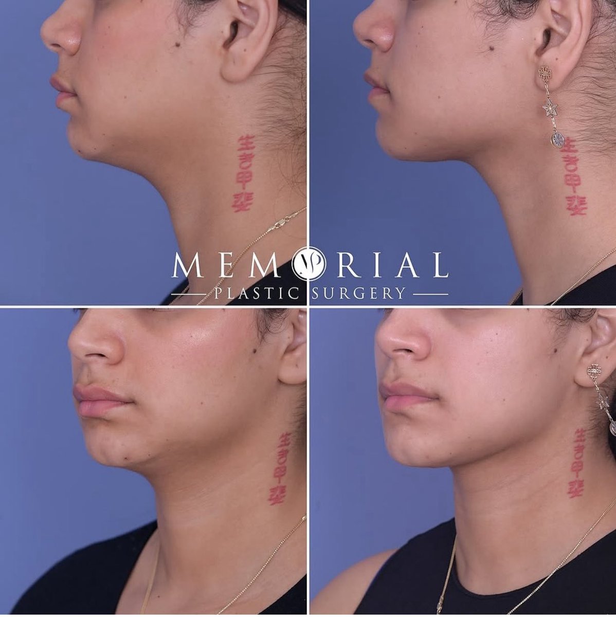 MPS_Surgeons's tweet image. One month post-op from Submental Liposuction w/ Dr. McElwee and the definition is already coming through 😍✨

#jawlinegoals #chinlipo #facialplasticsurgery #houstontx #MPSFace
