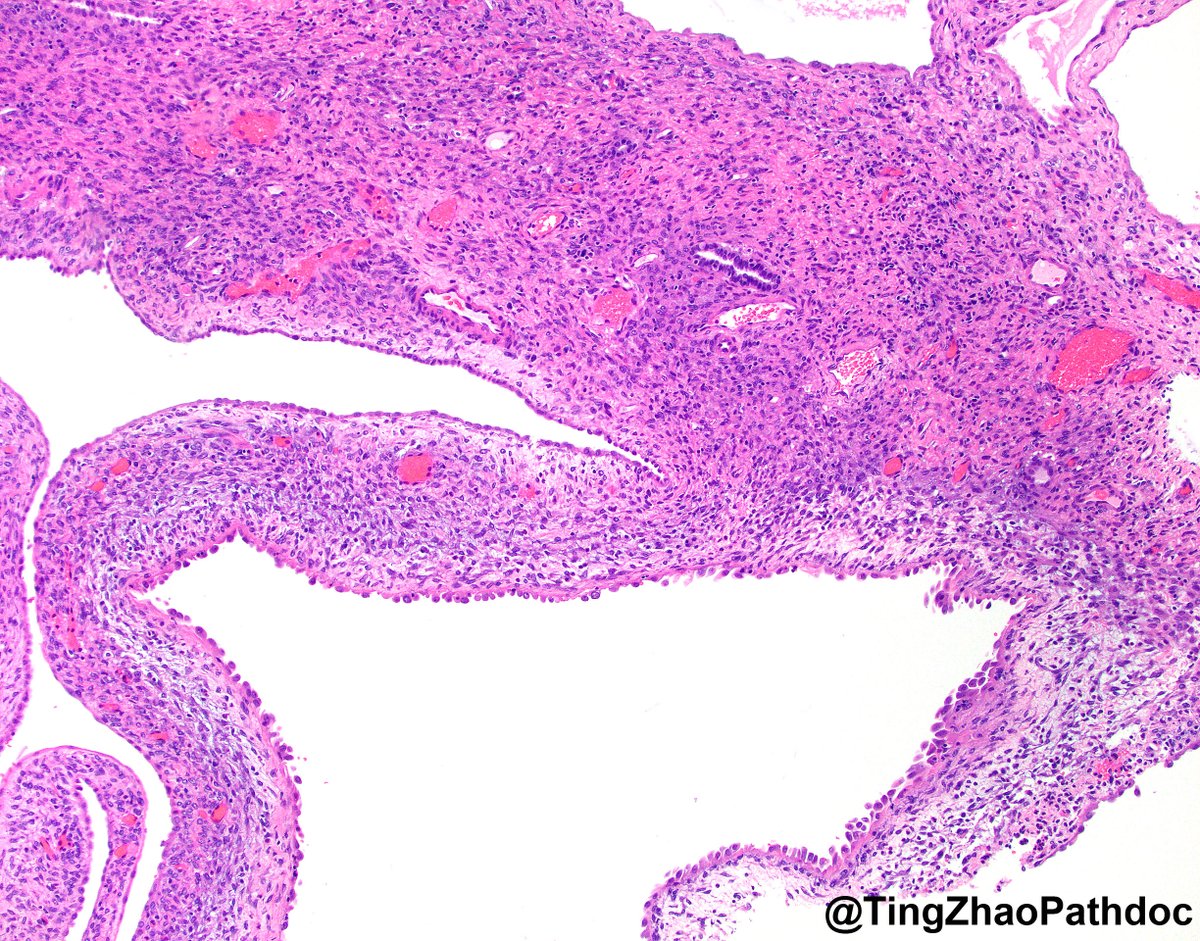 40s F with a renal mass. Gross photo in the chat. What is your diagnosis?
#PathTwitter 
<a href="/MGBpathology/">Mass General Brigham Pathology</a>  <a href="/MGHPathology/">MGH Pathology</a>