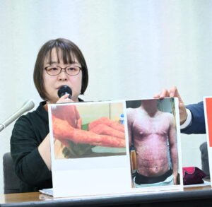 chng.it/LXh9ZrRZnw
#OTC類似薬の保険除外に反対します
魚鱗癬は、全身の皮膚が乾燥して硬くなりボロボロと剥がれるので皮膚の機能が正常でなくなり、アレルギーが強く出て、強い痒みと痛みが伴ったり、体温調整が出来なかったりします。