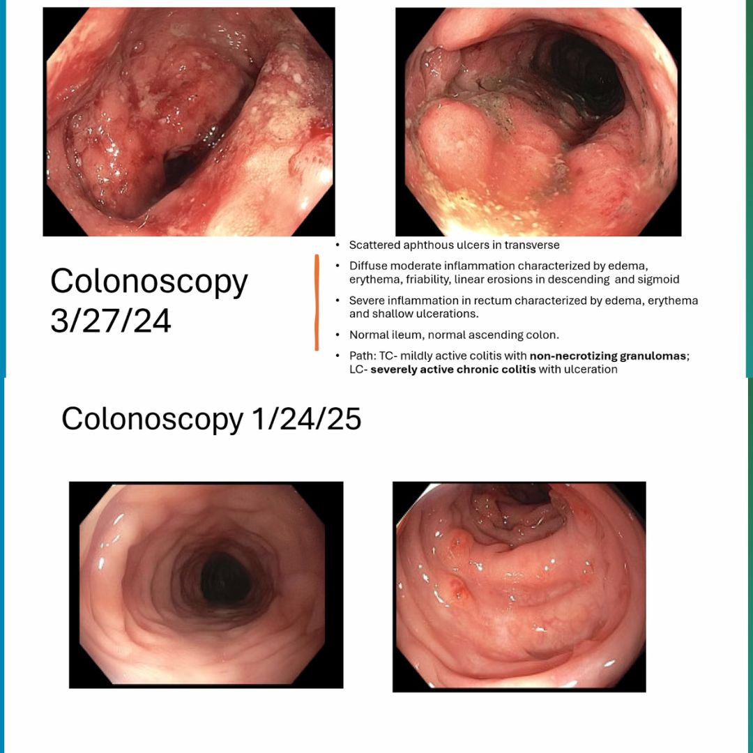 drRobinDud's tweet image. 1⃣st in🆕school year @ibdlive with Prof @MRegueiroMD 

2⃣ didactic cases that NOT every macroscopic view of intestinal🔥inflammation is only @IBD
from @HenryFordHealth &amp;amp;  @CleClinicMD 

3⃣important take🏠home messages when managing #IBDpatients

@ClevelandClinic #colitis #crohns