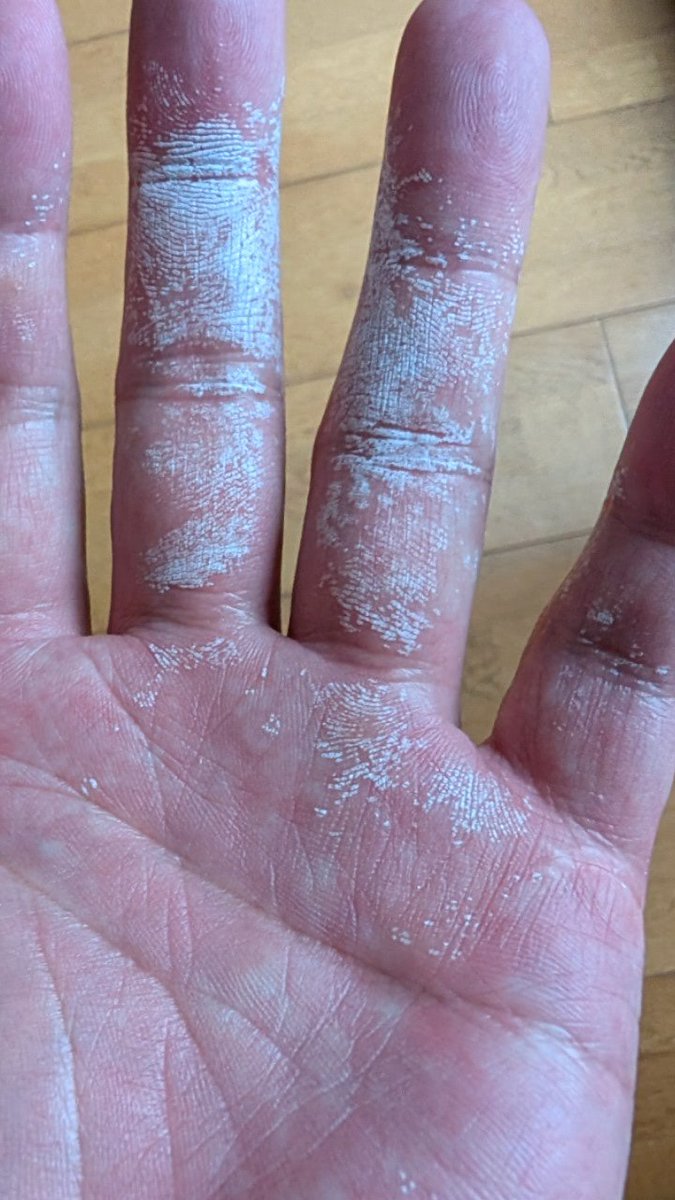 maru960's tweet image. これなんの症状か分かる方いますか？
「癜風でも水虫でも無い、菌なら出っぱなし。」と皮膚科の医師に言われたんですけど、すごく痒いんです。

風呂はいったら、一時的に消える。
石鹸で洗ったら、少し引っ込む。
粉吹いてるのではなく、皮膚が変色してる。

#皮膚
＃皮膚の病気
#菌