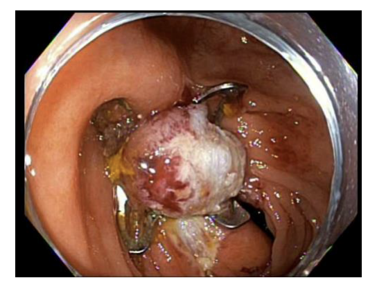 RahulKarnaMD's tweet photo. 🚨 Large, recurrent polyps near IC valve 🤯 can be difficult to ✂️
Check out 👇 case @iGIEjournal demonstrating feasibility of:
Multi-staged #EFTR for ✂️ large, recurrent polyp in challenging locations
@BilalMohammadMD @nataliejowilson #TaylorBowler https://t.co/TFX0dglCOz