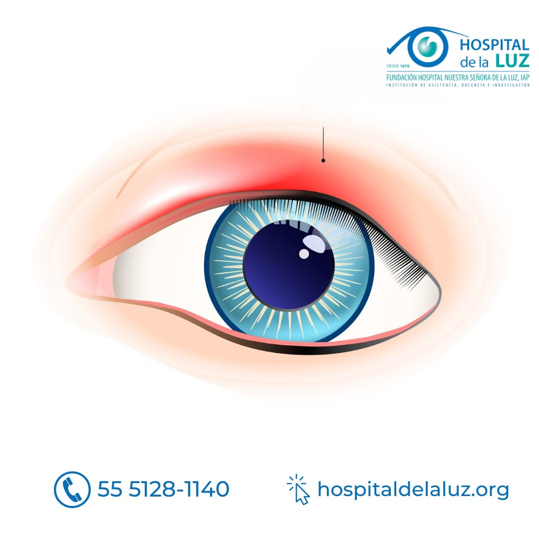 La hinchazón de los párpados puede producirse a causa de un trastorno ocular o del párpado, o por un trastorno en alguna otra parte del cuerpo.