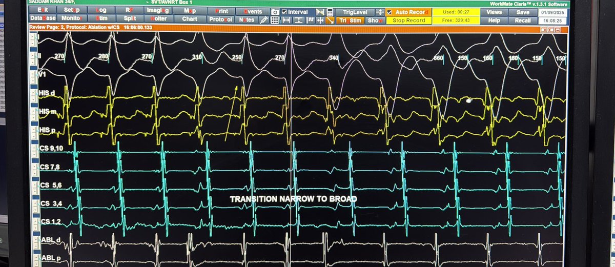 Differentials of this trace
TCL increased from 270msec from left to right
#eppeeps