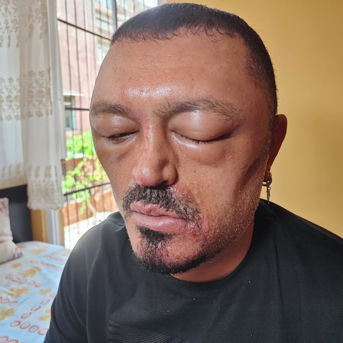 denetlecomtr's tweet photo. Adana'da gittiği berberin tavsiyesiyle  internetten saç siyahlaştırıcı şampuan alan vatandaşın yüzü bu hale geldi. https://t.co/Al8bx66y7h