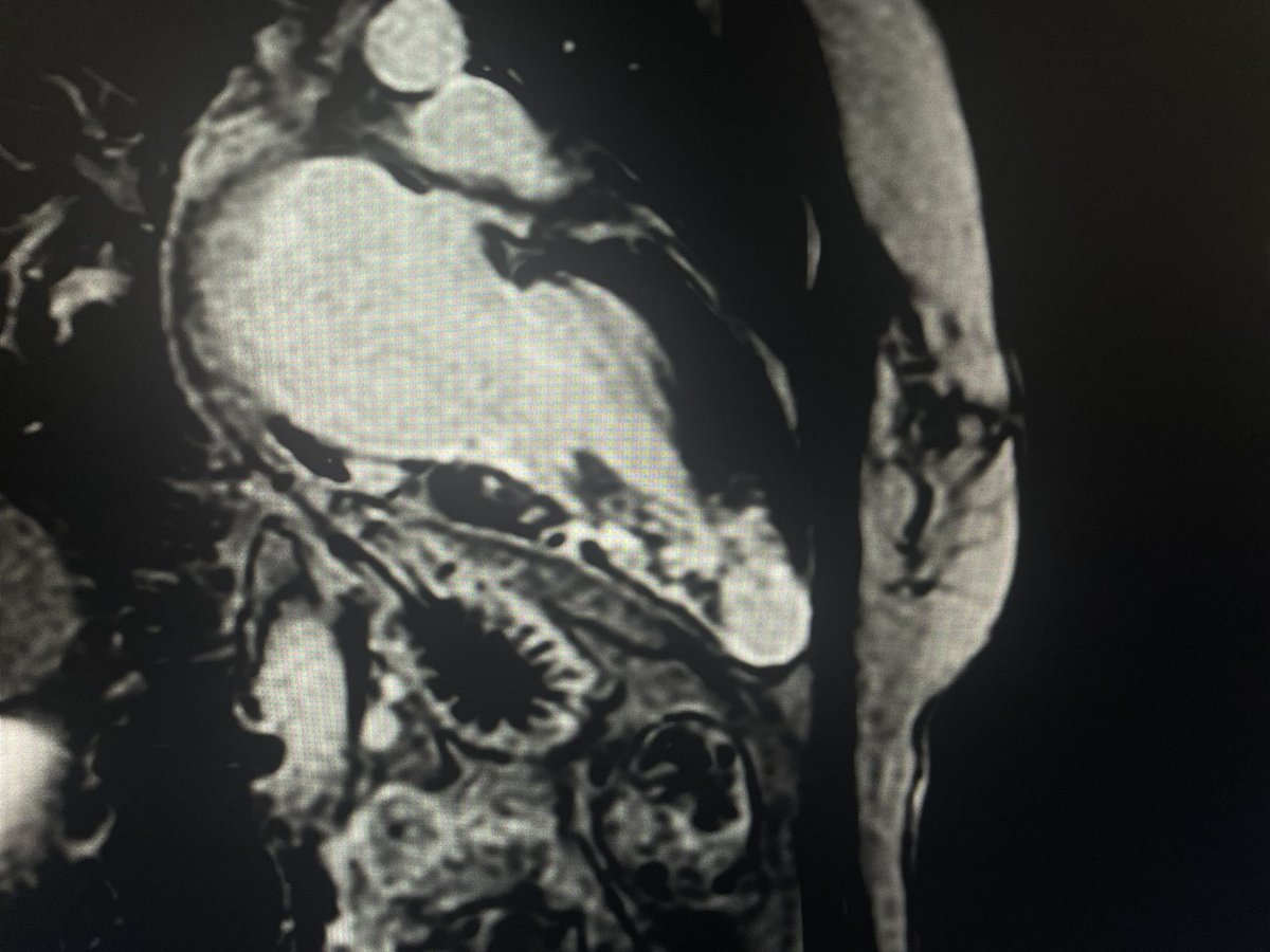 FedericaFras's tweet photo. 40 yo women 
‼️admitted to the hospital for AF

🧠CMR revealed mid ventricular HCM associated with an apical aneurysm 

⚠️ Why it matters:
↑ Risk of ventricular arrhythmias and SCD
↑ Risk of apical thrombus &amp; embolism

#HOCM #apicalaneurysm #CMR https://t.co/nb2w1YVKWg