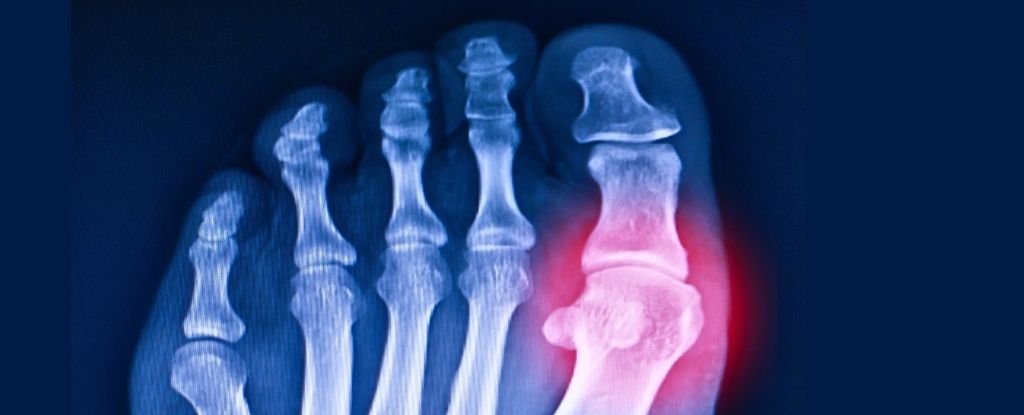 Scientists Revive 20-Million-Year-Old Gene to Help Fight Gout / Click->sciencealert.com/scientists-rev…