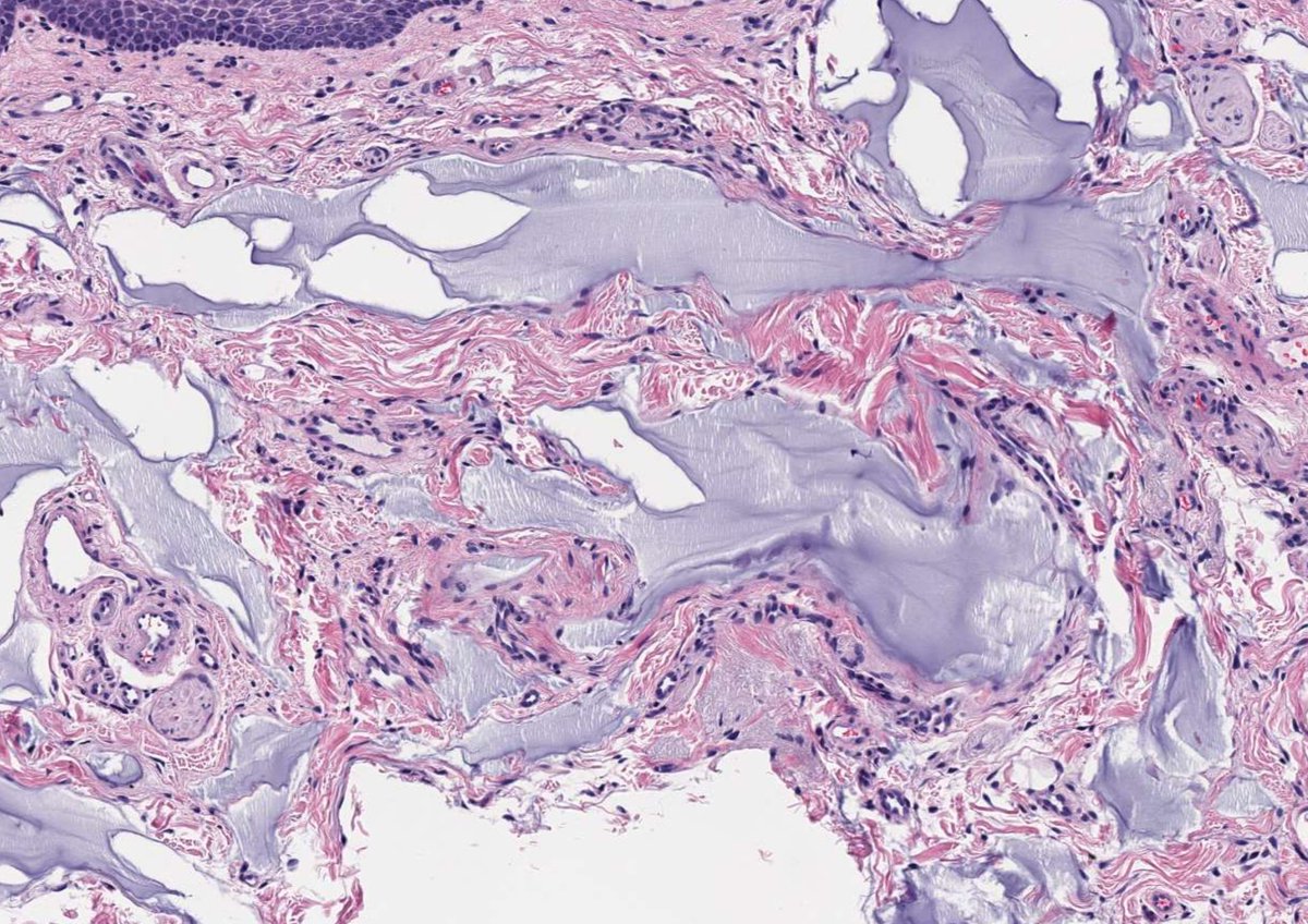 A 59-year-old female with a lip lesion #oralpath #oralpathology #pathology #pathologists #pathTwitter #HeadNeckPathol #HeadandNeckPath #ENTPath #PathologyTweet #dermpath
