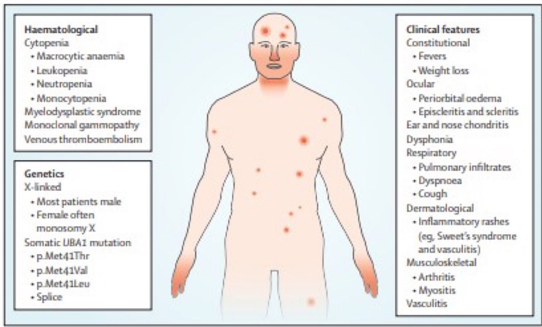 🧩 VEXAS Syndrome — Insights from The Lancet Rheumatology
•Newly identified disorder at the crossroads of rheumatology &amp; haematology
•Triggered by somatic UBA1 mutation → defective ubiquitylation &amp; immune overactivation
•Leads to systemic inflammation with rheumatic-like