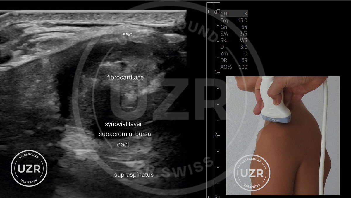 AC joint injection
x.com/search?q=from%…
One of my favorite technique:
x.com/Rheumatology/s…