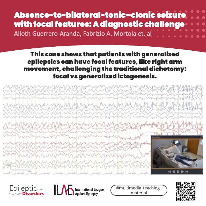 A 29-year-old’s seizures blurred the lines between focal and generalized epilepsy, showing why detailed monitoring is key for accurate diagnosis.

🔗 onlinelibrary.wiley.com/doi/10.1002/ep…

<a href="/joanajribeiro/">Joana Ribeiro</a> <a href="/giocastellucci/">Giovanni Castellucci, MD, MS</a> <a href="/krishnap15/">Radhakrishna</a> <a href="/SBeniczky/">Sandor Beniczky</a> <a href="/AnphyLab/">The AnPhy Lab</a>