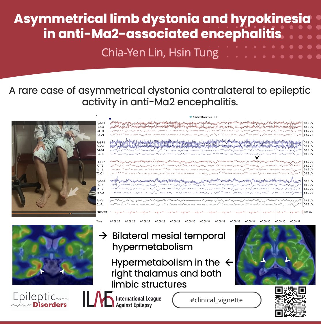 Left-sided dystonia in Anti-Ma2 encephalitis highlights altered brain networks, linked to right temporal epileptic activity &amp; hypermetabolism in the right thalamus. 🧠⚡

🔗doi.org/10.1002/epd2.7…

<a href="/joanajribeiro/">Joana Ribeiro</a> <a href="/SheikhISMD/">irfan sheikh 伊凡</a> <a href="/SBeniczky/">Sandor Beniczky</a> <a href="/krishnap15/">Radhakrishna</a> <a href="/giocastellucci/">Giovanni Castellucci, MD, MS</a> <a href="/AnphyLab/">The AnPhy Lab</a>