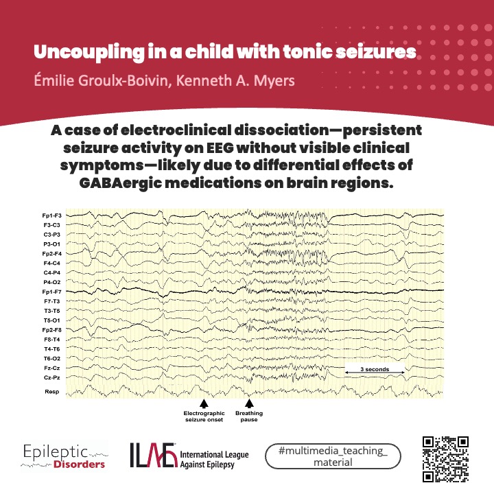 A 6yo developed super-refractory SE. EEG showed seizures—but no visible signs.

⚠️ Electroclinical uncoupling means seizures can persist silently, even as meds stop convulsions.

🔗onlinelibrary.wiley.com/doi/10.1002/ep…

<a href="/giocastellucci/">Giovanni Castellucci, MD, MS</a> <a href="/joanajribeiro/">Joana Ribeiro</a> <a href="/SheikhISMD/">irfan sheikh 伊凡</a> <a href="/SBeniczky/">Sandor Beniczky</a> <a href="/AnphyLab/">The AnPhy Lab</a>