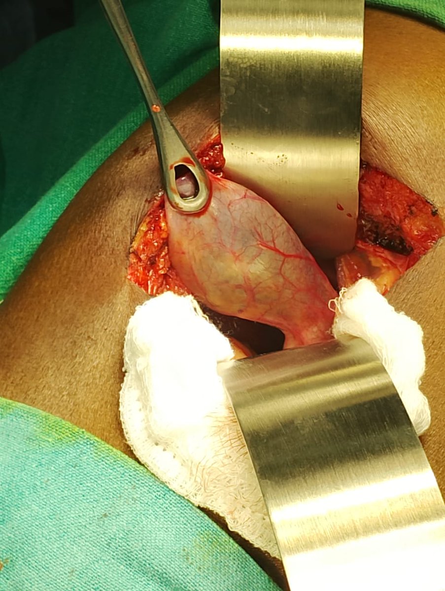 compositehospi2's tweet photo. 2 Successful surgery done at CH SSB Salonibari
1️⃣ A 37-year-old male patient successfully underwent Cholecystectomy under General Anesthesia.
2️⃣ A 35-year-old male patient underwent Jaboulay’s procedure for a large left-sided hydrocele, with approximately 200 mL fluid drained. https://t.co/8PsheC8Qms