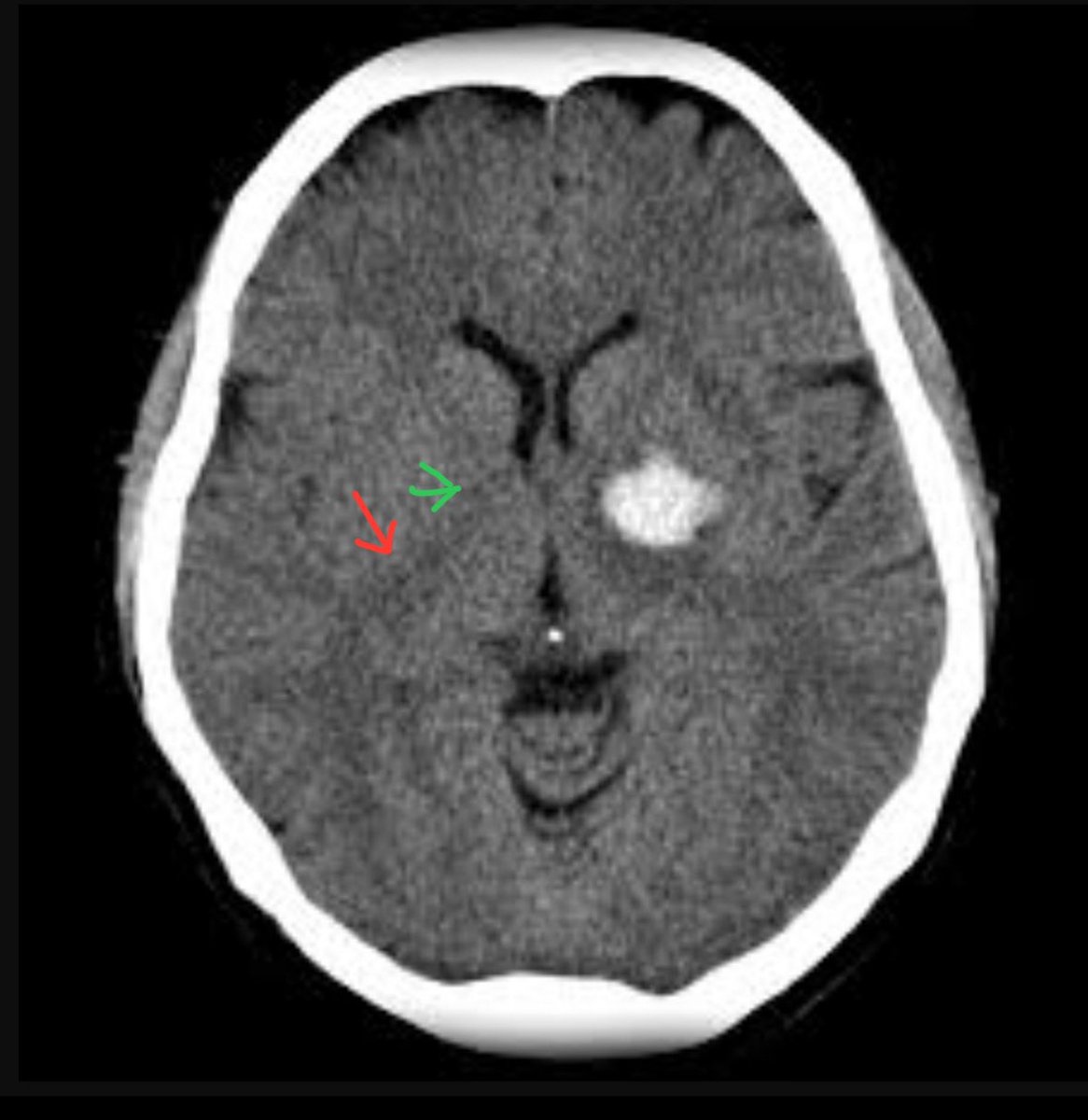 This is an acute intracranial hemorrhage in the basal ganglia — a common location for hemorrhage due to high blood pressure (hypertension).

Symptoms?
•Headache
•Significant weakness in the right upper &amp; lower extremity
•Dysarthria and facial droop

Why?
The blood sits next to