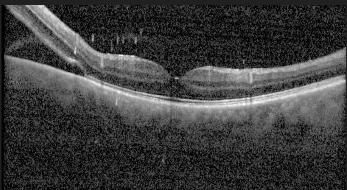 Fovea threatening retinal detachment.