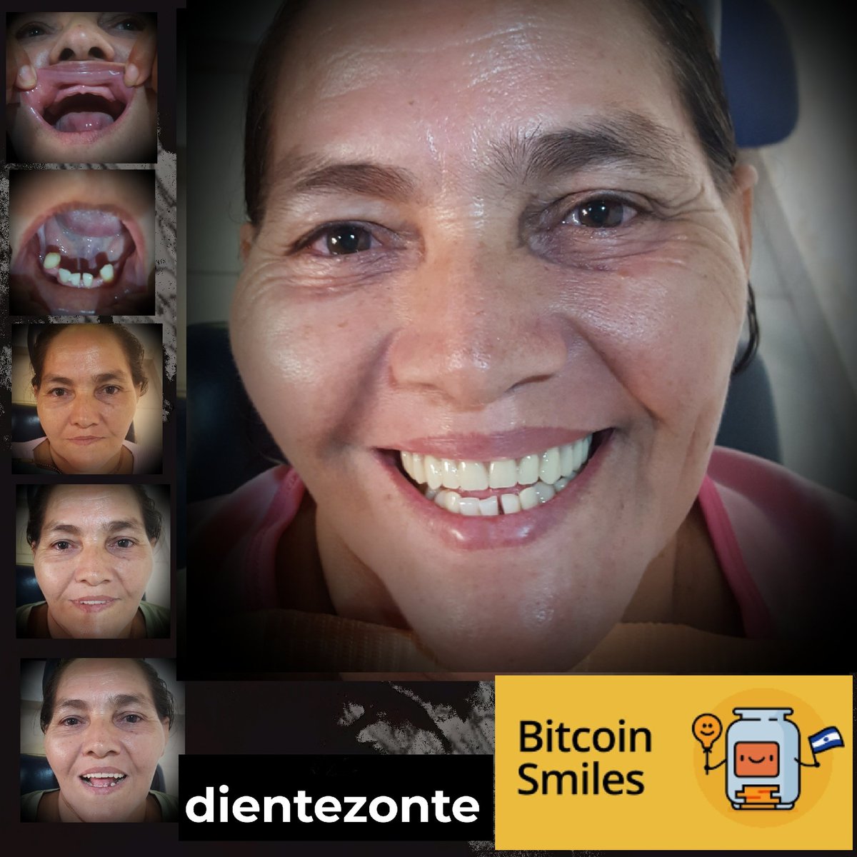 15 years ago, she had a kidney surgery and for 25 years, has been missing almost all of her teeth. Due to limited financial resources, never had access to dental rehabilitation. Cándida now is improving her chewing ability and self-esteem + glowing with her new beautiful smile 🦷