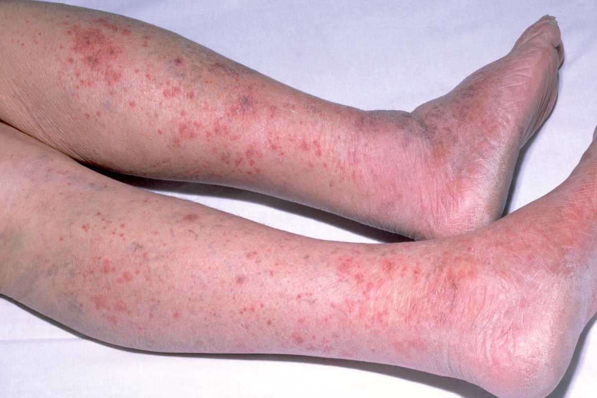 Babies are the most vulnerable among us to many diseases, including meningitis. 

Talk to your doctor about how to protect your child from this disease. No family should endure the pain of their child becoming infected or dying from this disease. The meningococcal vaccine is safe
