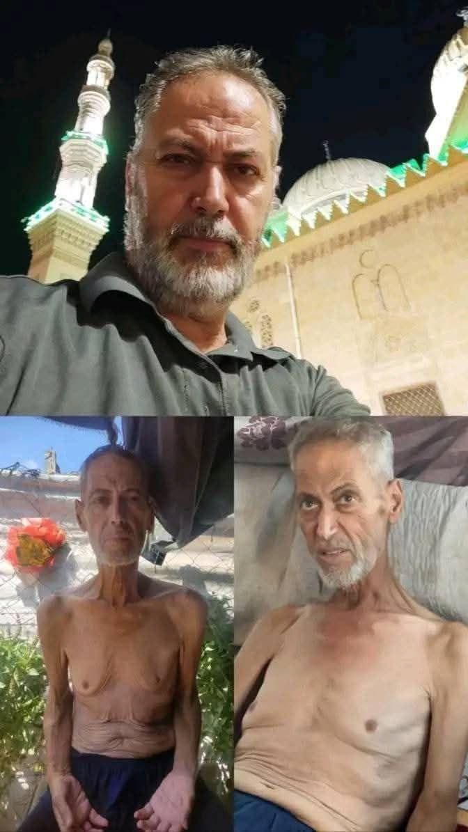 طبيب يتحول جسده الى هيكل عظمي في غزة نتيجة الجوع الشديد