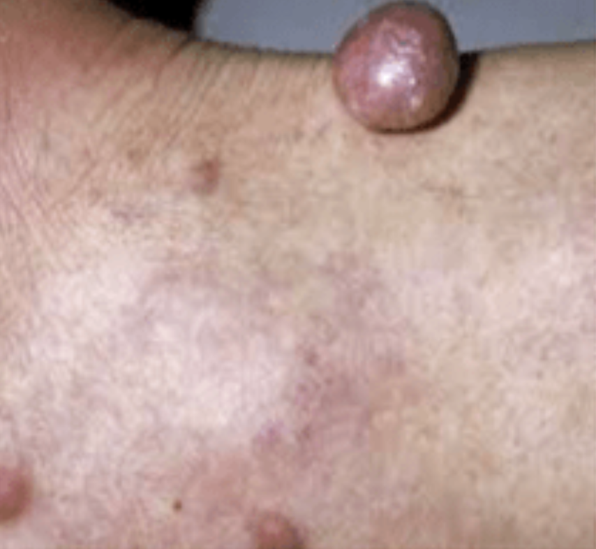 Images_Case's tweet photo. Juvenile Arcus Cornealis and Xanthomas in Familial Hypercholesterolemia: A 24-year-old gentleman, born of a non-consanguineous marriage, presented with multiple swelling over his body...https://t.co/mGAtxIBkaS https://t.co/j7lC5Q0jpA