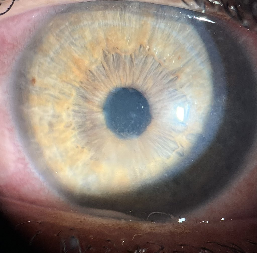 Acute anterior uveitis + hypopyon → think of:

1️⃣ HLA-B27 uveitis

2️⃣ Behcet’s disease (shifting sterile hypopyon)

3️⃣ Infective endophthalmitis (purulent)

4️⃣ Tuberculosis / Sarcoid (granulomatous)

5️⃣ Herpetic uveitis (with keratitis/↑IOP)

#Ophthalmology #MedTwitter
