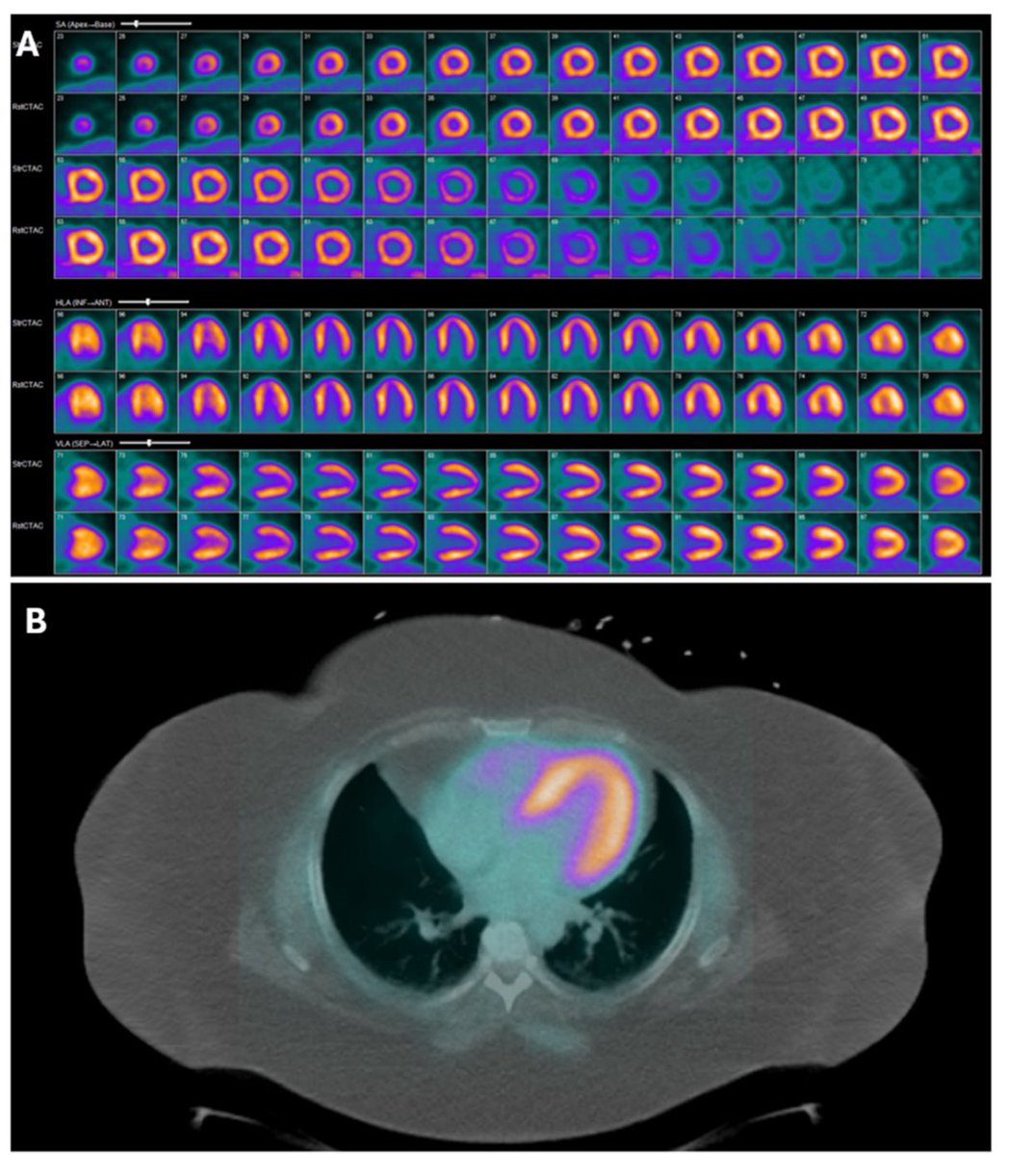 🚀 PET/CT is rocking in cardiology guidelines!
✅ Superior to SPECT for CAD &amp; CMD
✅ MBF/MBFR for risk stratification
✅ Stronger role in #Endocarditis, #Sarcoidosis, #Amyloidosis &amp; transplant vasculopathy
<a href="/escardio/">European Society of Cardiology</a> <a href="/American_Heart/">American Heart Association</a> 
journalofnuclearcardiology.org/article/S1071-…
<a href="/MyASNC/">ASNC Society</a> <a href="/JNCjournal/">Journal of Nuclear Cardiology</a>