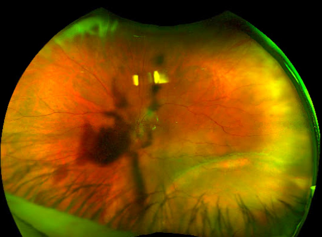 Eye with new vitreous hemorrhage and breakthrough subretinal fluid within temporal vascular arcades from chronic inferotemporal rhegmatogenous retinal detachment with demarcation line.