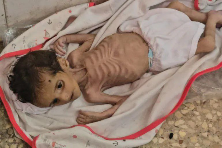 #عاجل | وزارة الصحة في غزة: 5 وفيات جديدة خلال 24 ساعة بسبب المجاعة وسوء التغذية، بينهم 3 أطفال، ليرتفع العدد الإجمالي إلى 387 وفاة، منهم 13 طفلًا.