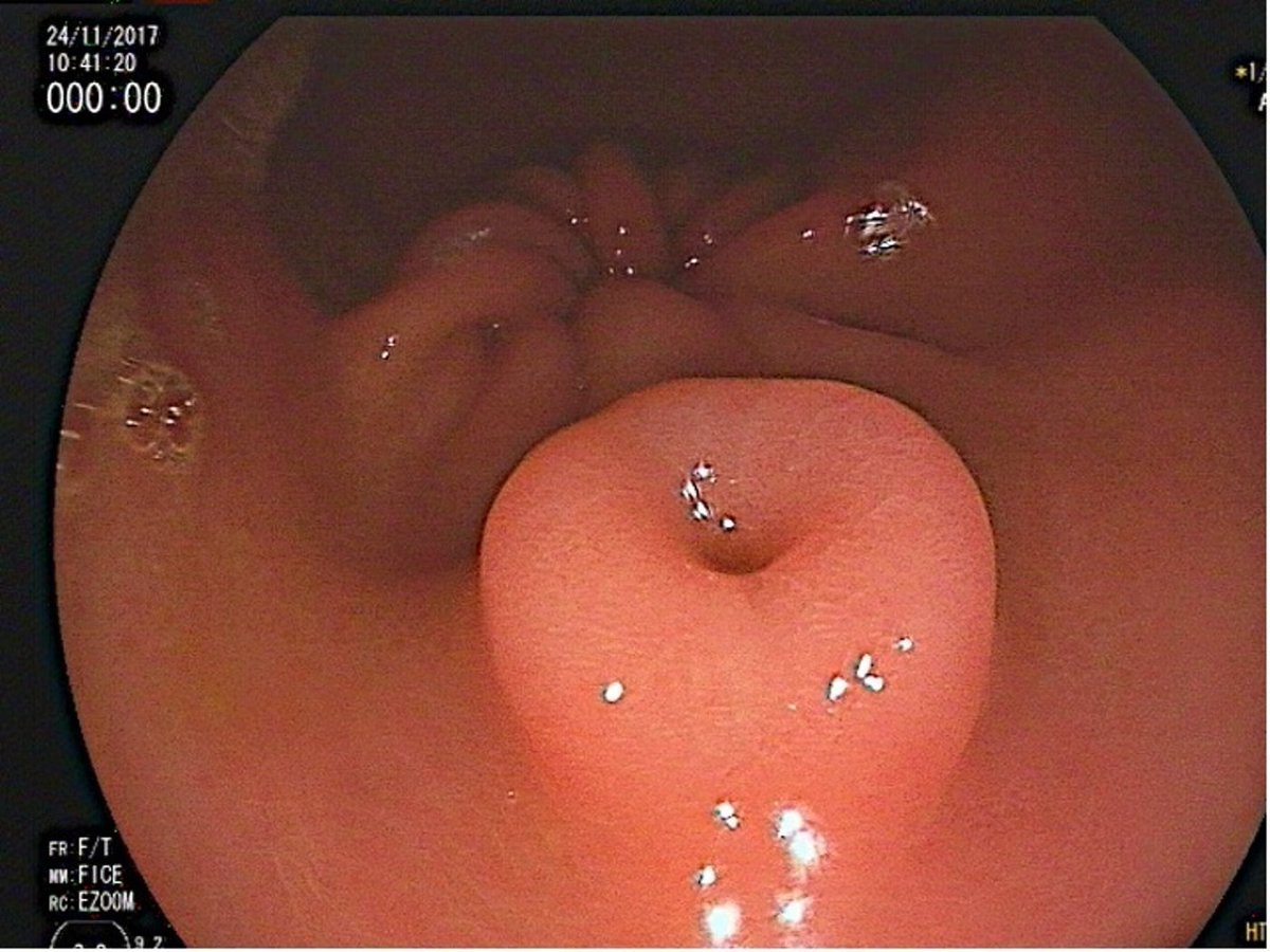 New Quiz

A "Funny Gastric Polyp"

This Polypoid Lesion With Depressed Center Is Located in the Antrum, Greater Curvature, Pre-Pyloric Area.

What Is the Most Likely Diagnosis?
