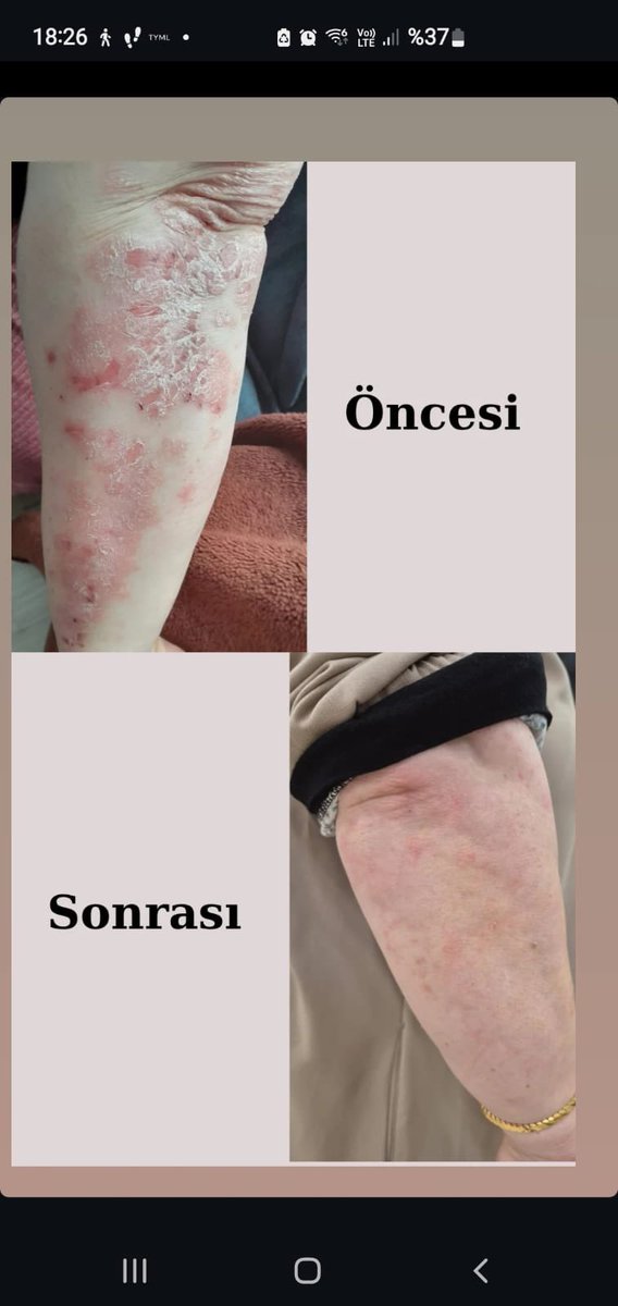 doakozmetik's tweet photo. Bakın şimdi şelatlayıcı teknoloji nasıl etki ediyor anlatayım. 

Sls sles ve sabunla cildi yıkamaktan kurtarınca cilt kendini onarmaya zaman buluyor. Sbr şampuan atp sıvı sabun atp nemlendirici ve atp losyon kullanarak 20 günde bu hale gelmiş durumda. İzmit Foko paylaştı görseli.

Olay tamamen bakış açısıyla alakalı. 

Ha sizde bu etkiyi yapabilir mi. Belki evet belki hayır. Sadece fikriniz olsun diye yazıyorum.

O 100 liralık şampuanlar sıvı sabunlar katı sabunlar cildinizi çok aşındırıyor. Yıkama teknolojisini değiştirmek gerekiyor.

Bu şelatlayıcı aminoasitli temizleyicileri de biz geliştirdik, suya suyun ortalamasına göre. Böylece cildi nazik temizleyip, sudaki kirecin vb şeylerin cildi aşındırmasınının önüne geçiyorsunuz.

ABD, Avrupada falan olsa, haber kanalları influancerler peşimizde gezer her gün bir yere çağırırlar. Türkiye olunca kimse selam vermiyor rüşvet değildür deyü