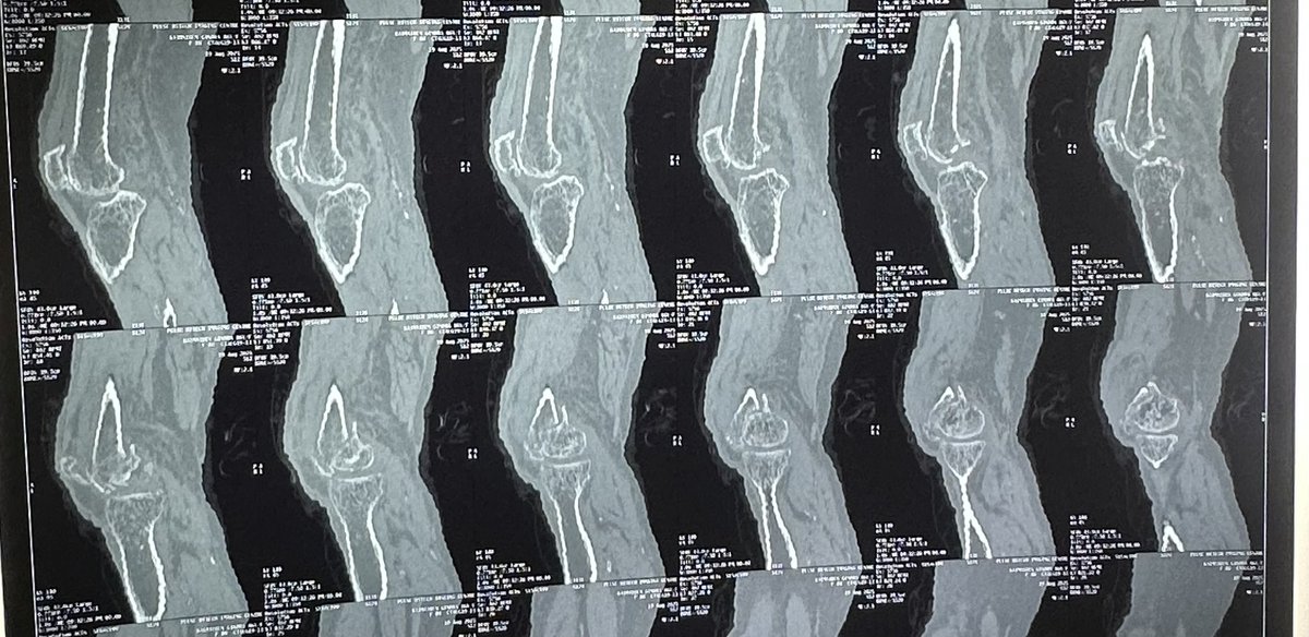 MusclTwitch's tweet photo. 85/F 
Medial condyle fracture 
What &amp; How can it be done ? 
TKR with fixation of medial condyle fracture 
#orthotwitter @orthobullets  #orthox @traumaticum @generalorthomd @anilbhatortho @Davembmd @doc_mehta @ms_keyur @pratikorho https://t.co/sK5UFueNTr