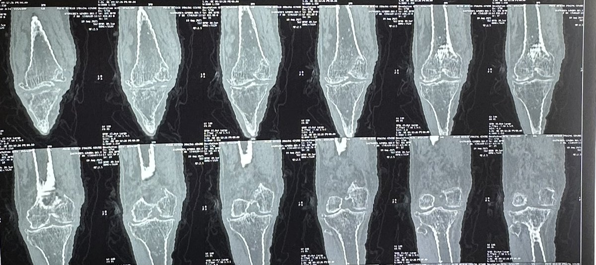 MusclTwitch's tweet photo. 85/F 
Medial condyle fracture 
What &amp; How can it be done ? 
TKR with fixation of medial condyle fracture 
#orthotwitter @orthobullets  #orthox @traumaticum @generalorthomd @anilbhatortho @Davembmd @doc_mehta @ms_keyur @pratikorho https://t.co/sK5UFueNTr