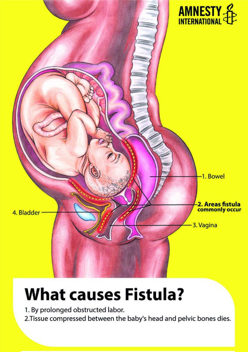 Hi X Family 👋!
Have you ever heard of obstetric fistula???
What do you understand or know about this condition?
It's not a disease. It's an injury. Imagine the uncontrollable leakage of faeces, blood and urine all through the vagina. The loss of human dignity.