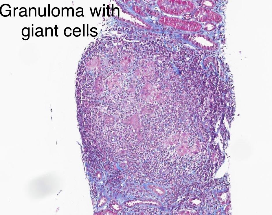 This one is a classic.

Large well demarcated granulomas with giant cells.

Dx: Granulomatous interstitial nephritis, associated with Sarcoidosis.

Differential diagnosis includes drug-induced interstitial nephritis.

60 yr-old with HTN, sarcoidosis &amp; rise in Cr from 1.1 to 2.5.