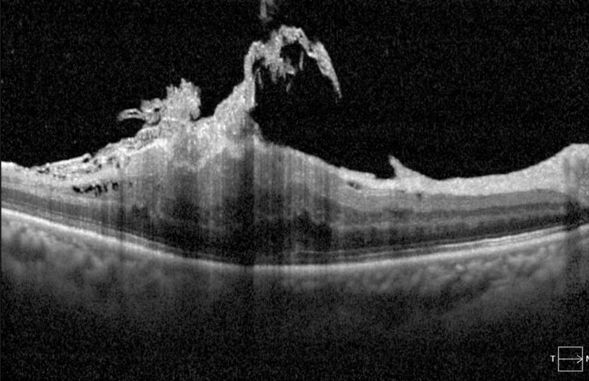 Epiretinal membrane.