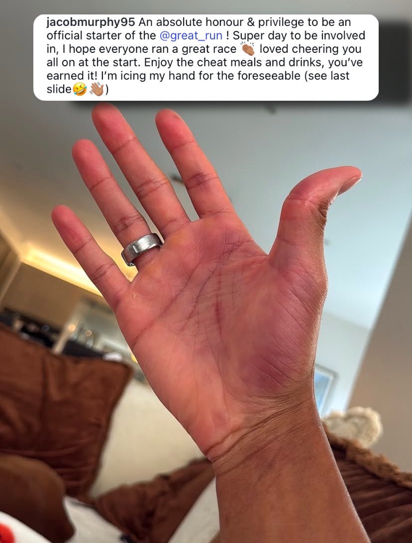 Jacob Murphy’s hand after the Great North Run… 🟣👋😂