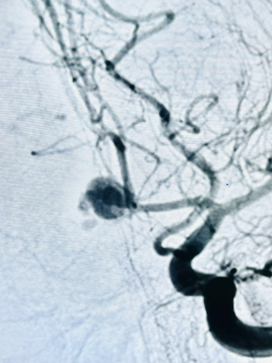 DrLe2287's tweet photo. Onyx–Coil remains the best option in this case, used to embolize a bleeding AComA aneurysm–pseudoaneurysm. #CoilOnyx #NeuroIntervention #StopBleeding https://t.co/QfhFoIXWEJ