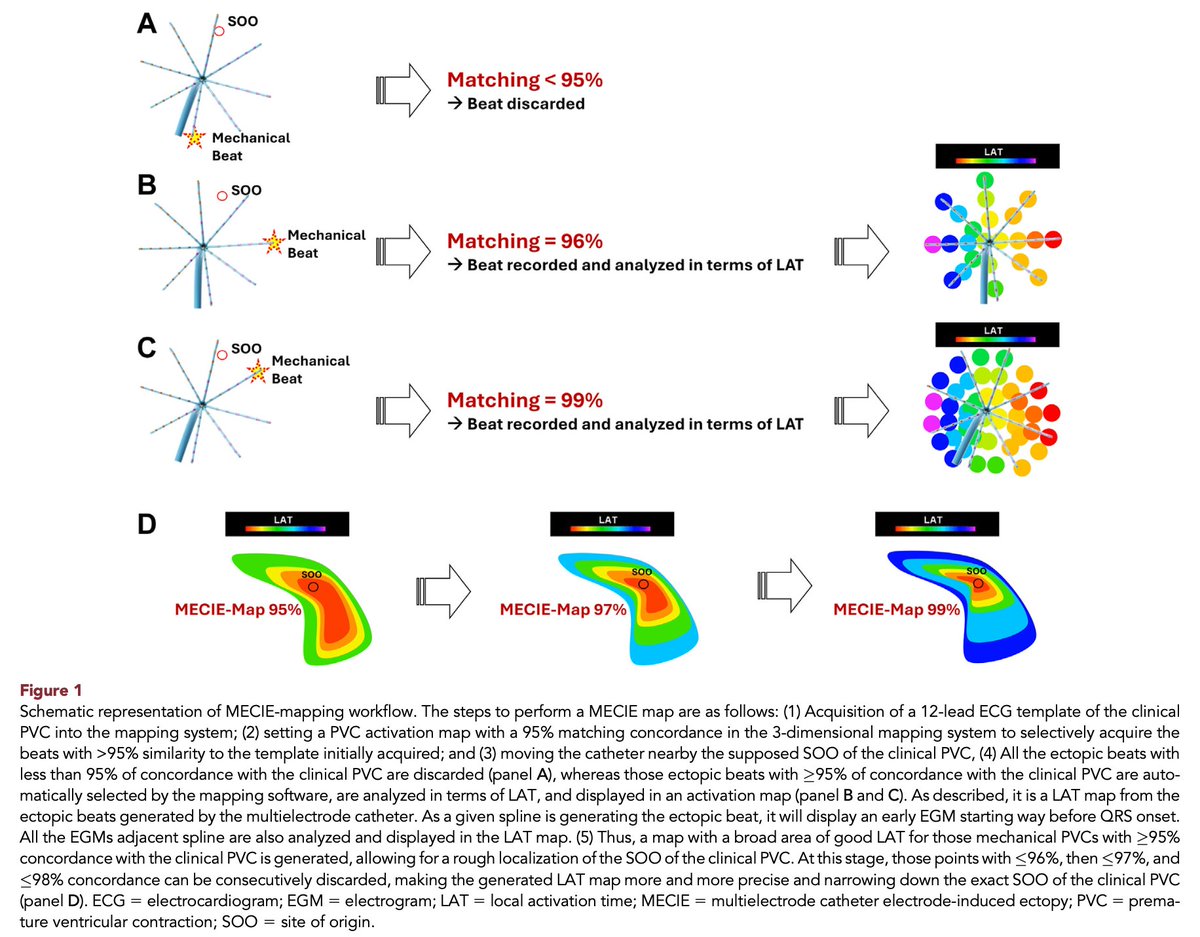 OctaRayカテによるPVCマッピング

カテ刺激でPVCが出やすいのを逆に利用？して
LATマップすることで簡易ペースマップが容易に完成

99%以上のマッチング率にすることでキレイに絞り込みができ、長期的PVC根治率93.1%✨

heartrhythmjournal.com/article/S1547-…