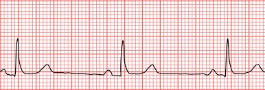 Bradycardia: 
• Atropine is the 1st-line drug for acute unstable bradycardia (except for heart transplant PT )
• 1mg IV every 3-5min
• TCP(pacing) 2nd-line
• Dopamine, epinephrine 3rd-line 
#ACLS