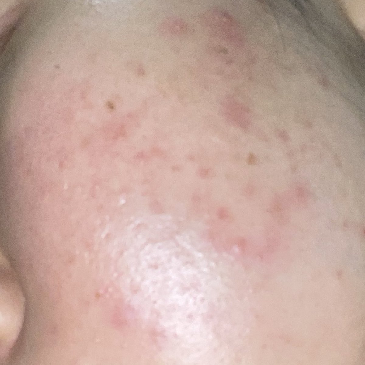 myssweatheart's tweet image. serum bukan sembarang serum, PANTESAN VIRAL BGT! seminggu pake aja udah kaya gini progresnya😍🫵
#glowskin #axisyglowserum #axisyindonesia

before.                                          after.