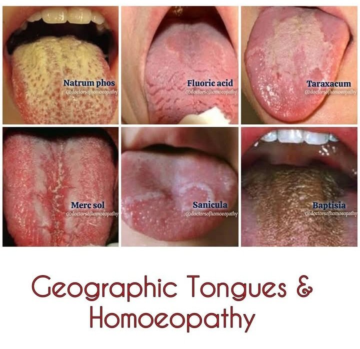 Characteristics tongues of some important medicines 🩺 
#Homoeopathy