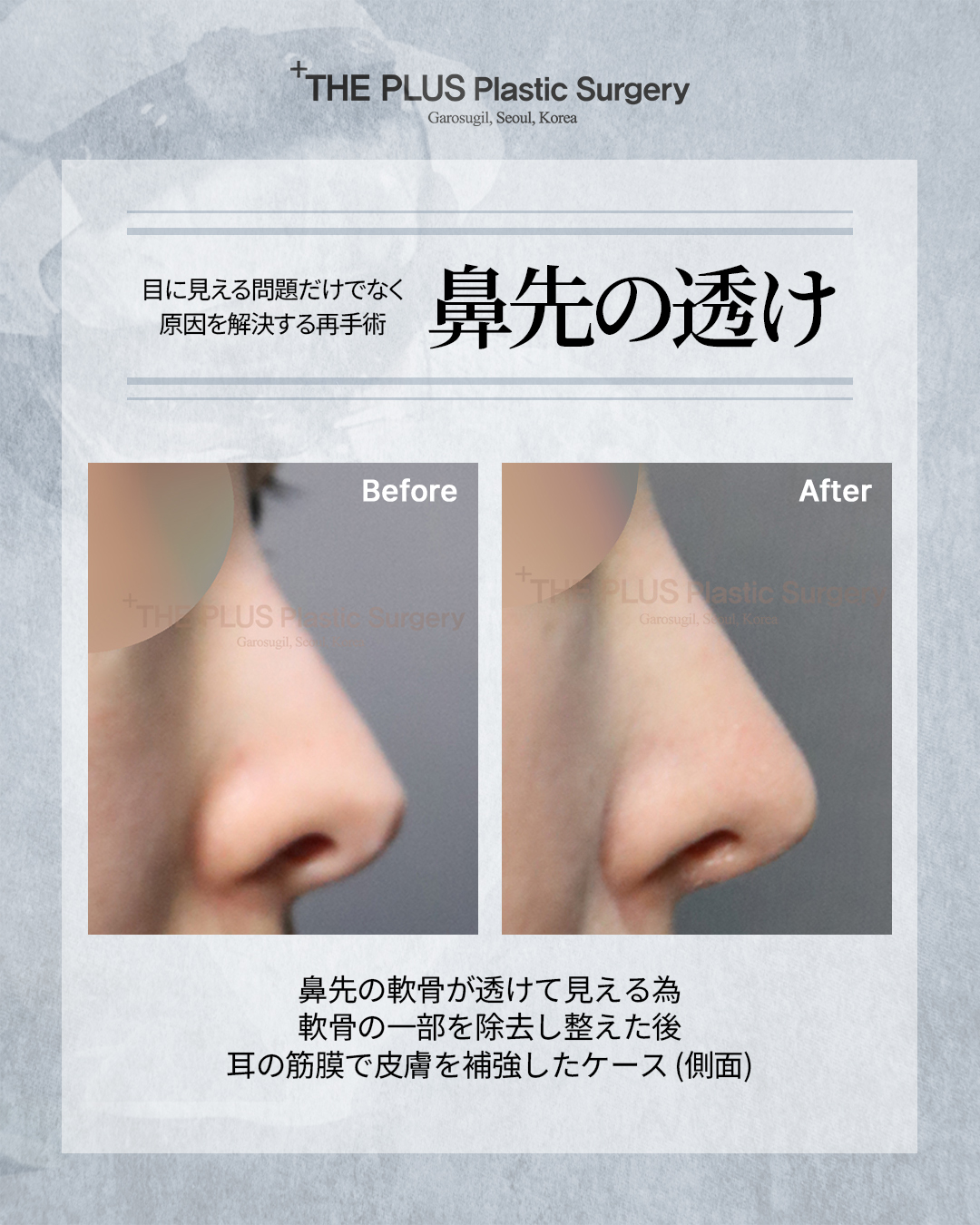 【裁断済】鼻形成術　ジョン・ジェヨン 鼻形成術 Rebuilding Nose | 鄭載用(ジョン・ジェヨン), Jaeyong