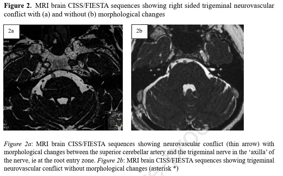 We have published our experience on "Trigeminal microvascular decompression for medically refractory Short-lasting Unilateral Neuralgiform Headache Attacks (SUNA)" <a href="/WorldNeurosurg/">World Neurosurgery Journal</a> 

doi.org/10.1016/j.wneu…

<a href="/SinanBarazi/">Sinan Barazi</a> <a href="/g_lambru/">Giorgio Lambru</a> <a href="/eleni_maratos/">Eleni Maratos</a>