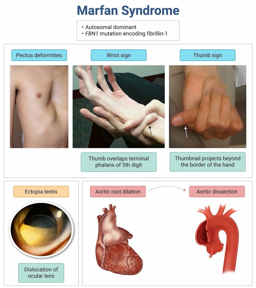 Marfan Syndrome ✨

🫥🫥🫥